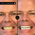 Results - 20 porcelain veneers in medellin, colombia for patient from FORT LOUDERDALE - BA-min