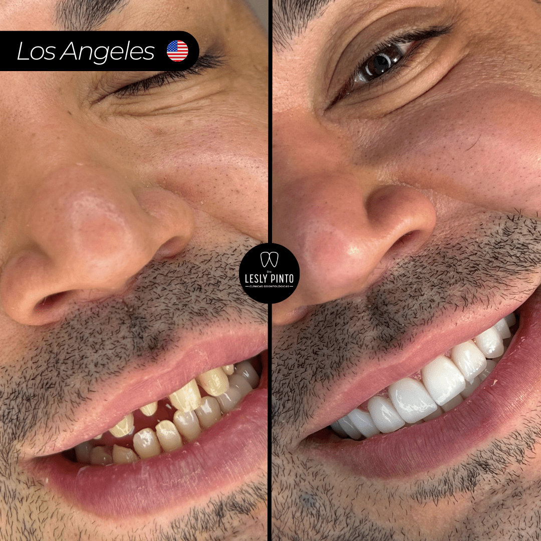 Results - 20 porcelain veneers in medellin, colombia for patient from LOS ANGELES - BA-min