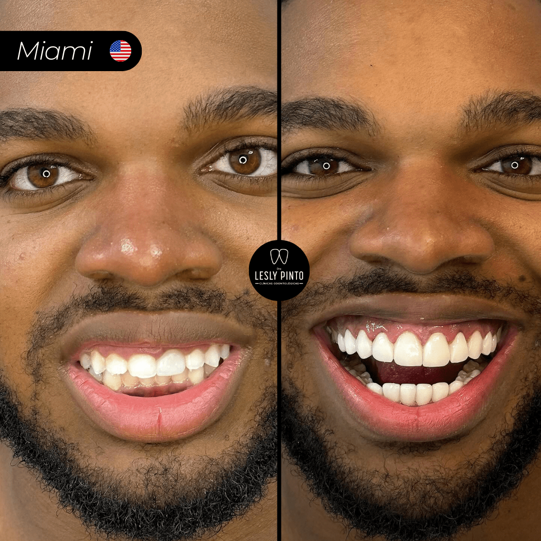 Results - Porcelain veneers in medellin colombia - 5