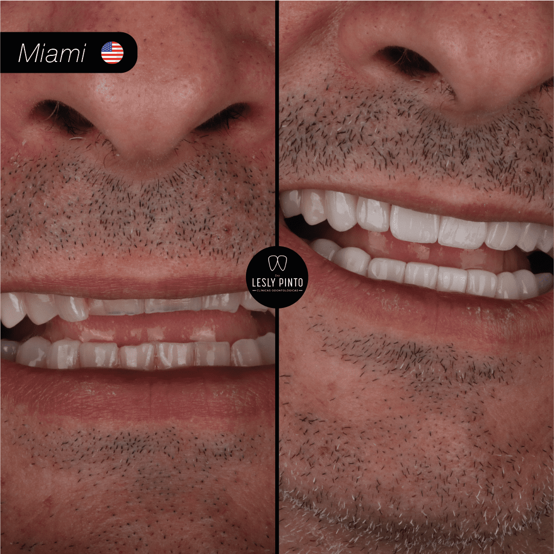 Results - 20 porcelain veneers in medellin, colombia for patient from MIAMI