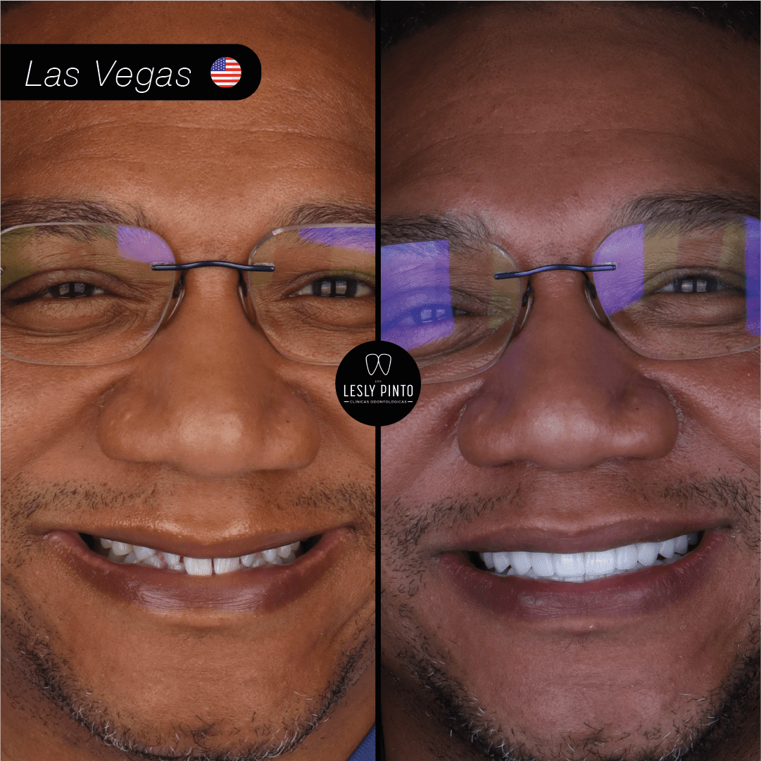 Results - 20 porcelain veneers in medellin, colombia for patient from LAS VEGAS
