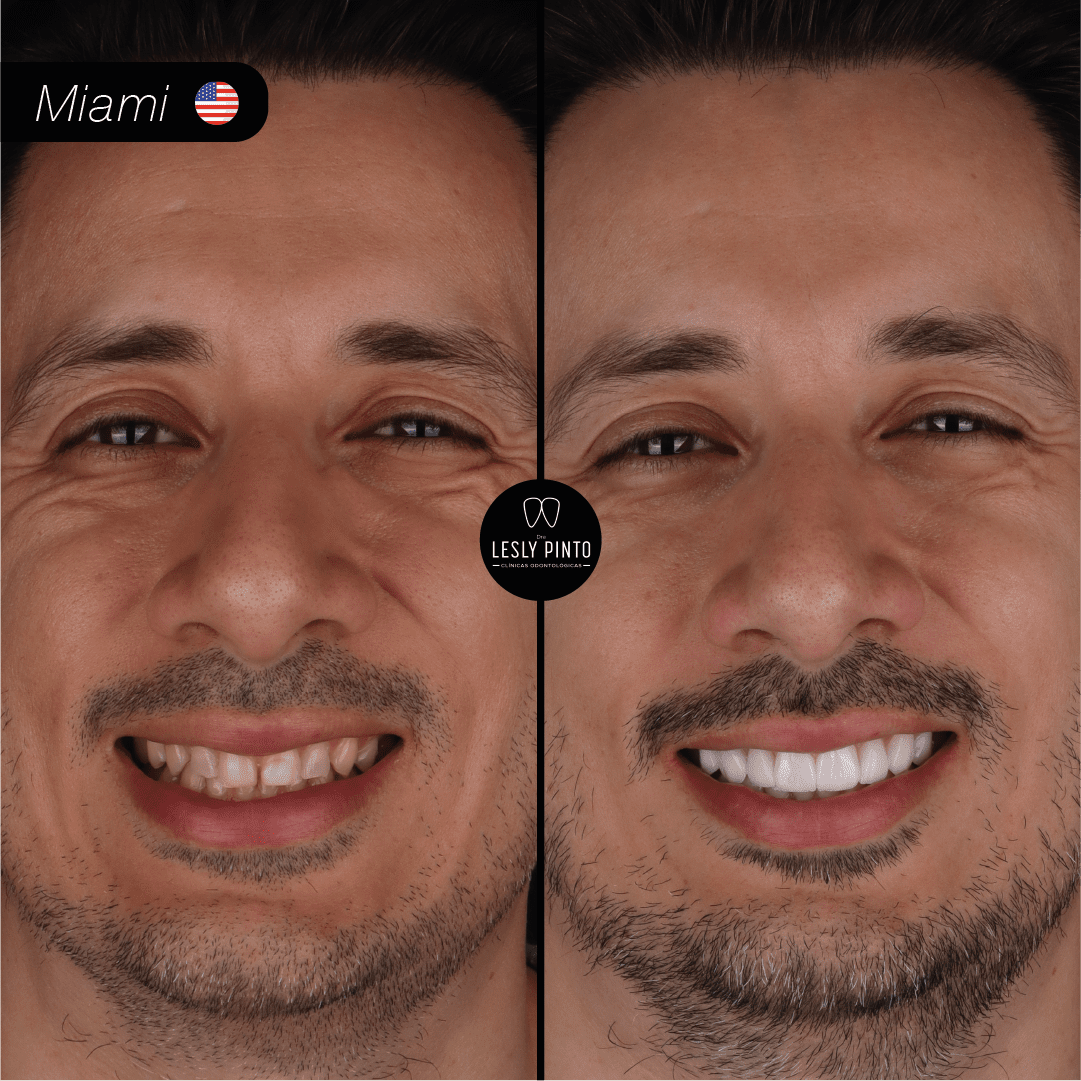 Results - 20 porcelain veneers in medellin, colombia for patient from MIAMI