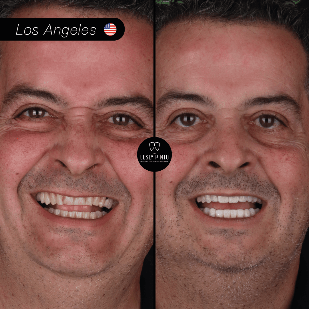 Results - 20 porcelain veneers in medellin, colombia for patient from Los Angeles