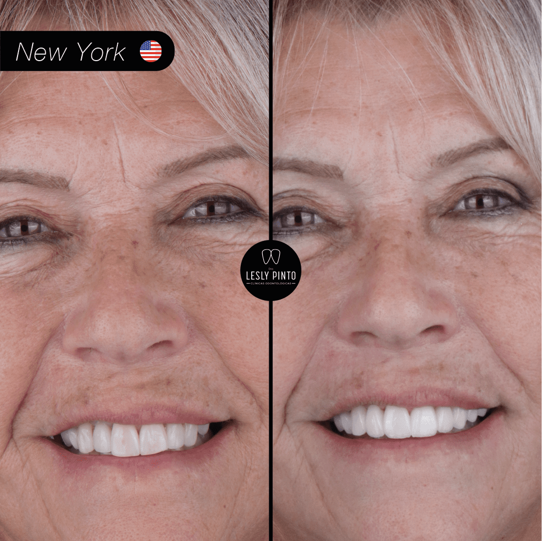 Results - 20 porcelain veneers in medellin, colombia for patient from NEW YORK