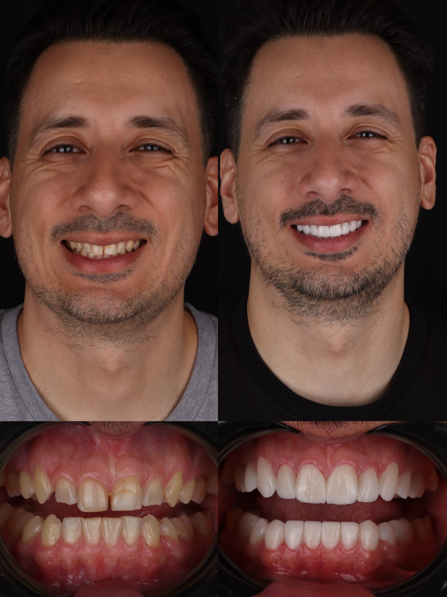 dental veneers in medellin - patient 3