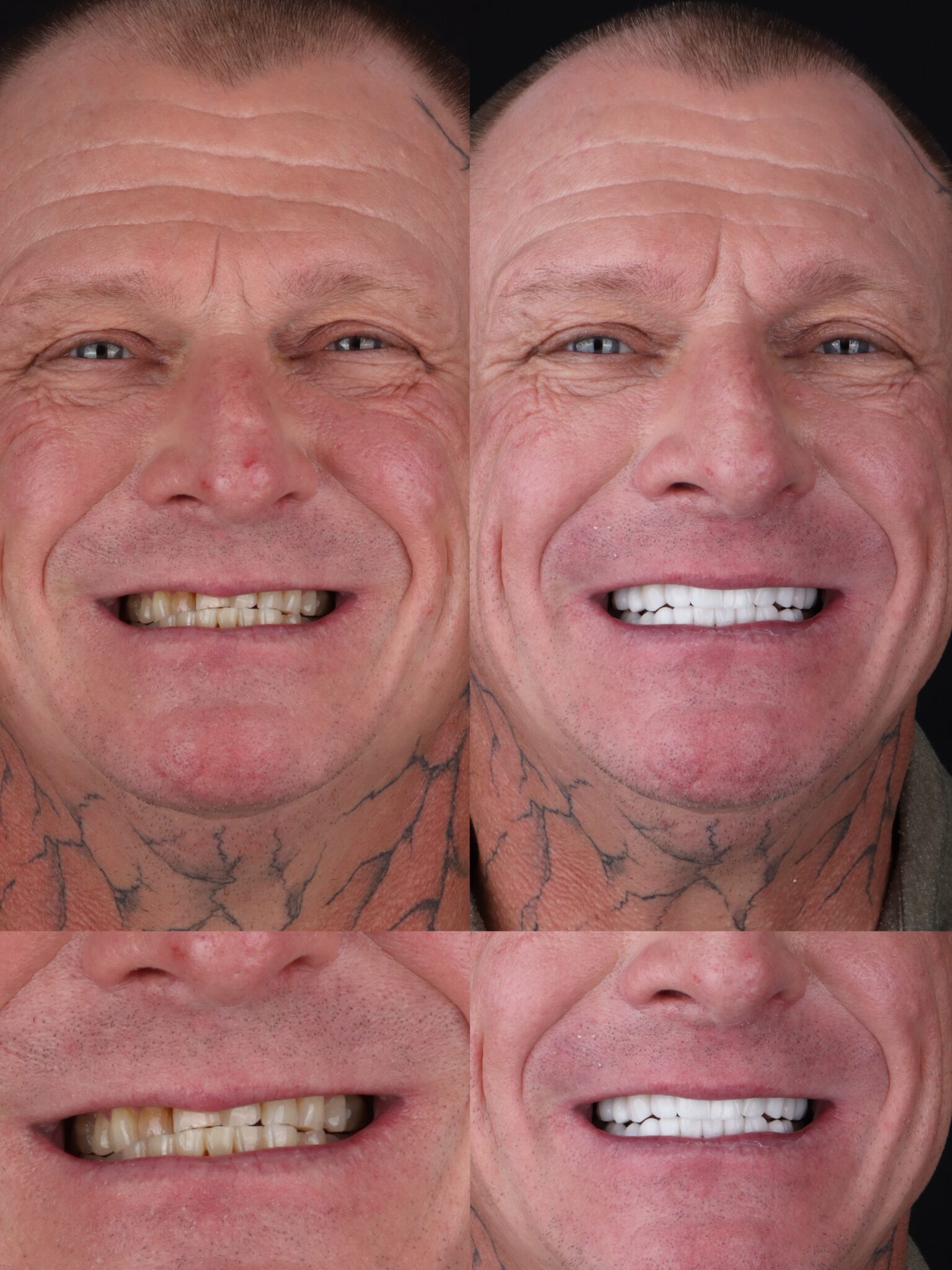 dental veneers in medellin - patient 2