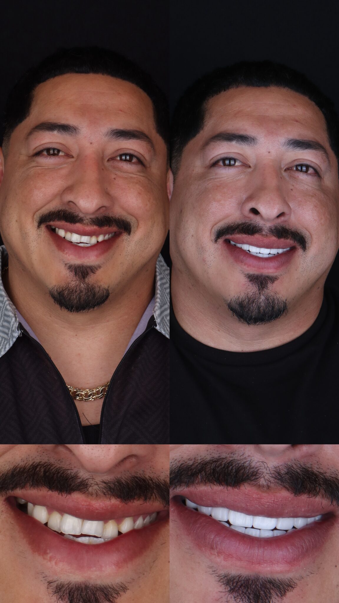 dental veneers in medellin - patient 7