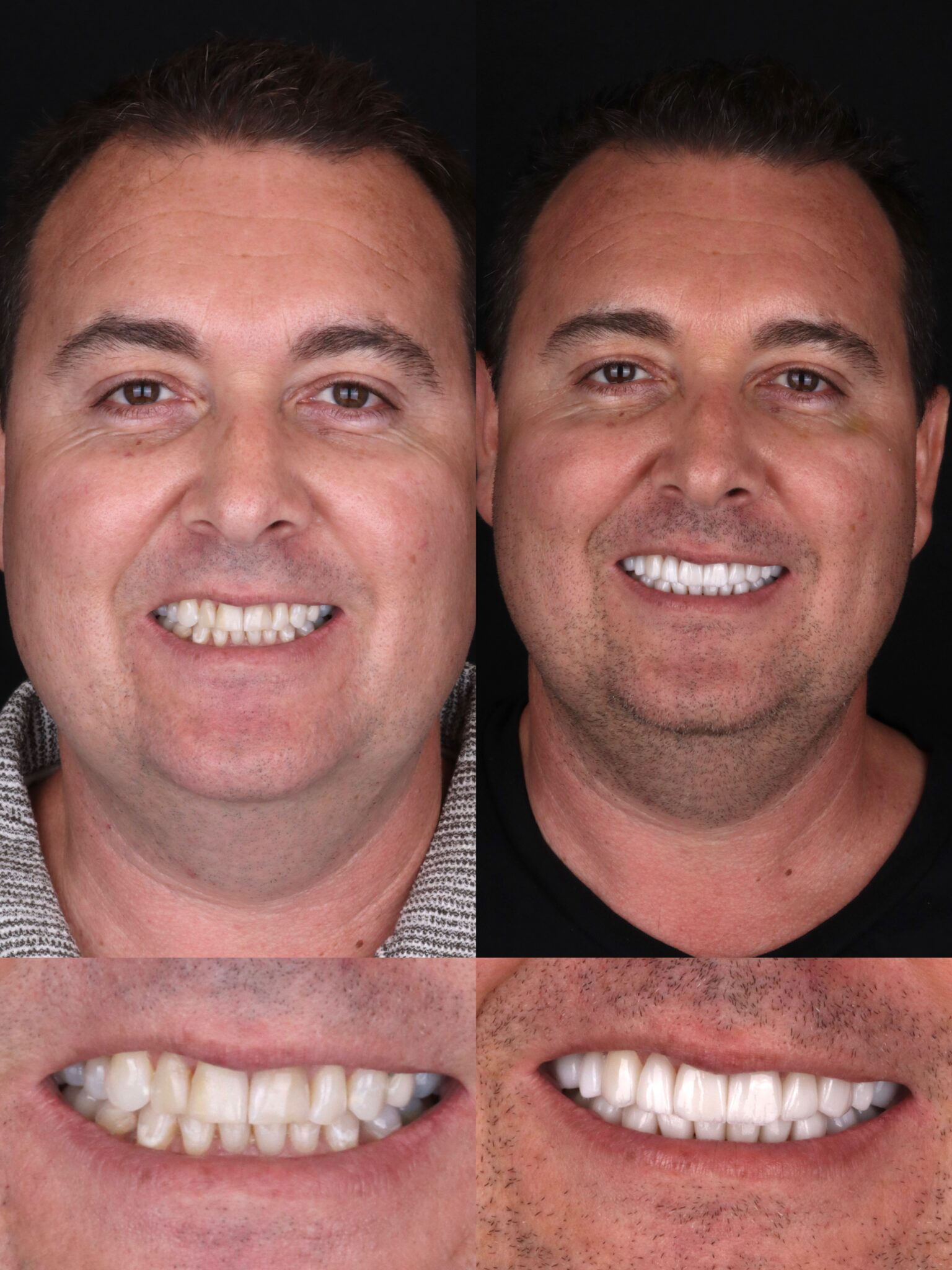 dental veneers in medellin - patient 8