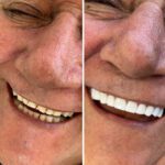 veneers in medellin by dentist in medellin