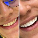 dental tourism in colombia, successful case 5