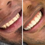 dentist in medellin and veneers in medellin - patient 2