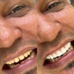 before afeter, veneers in medellin by dra lesly pinto