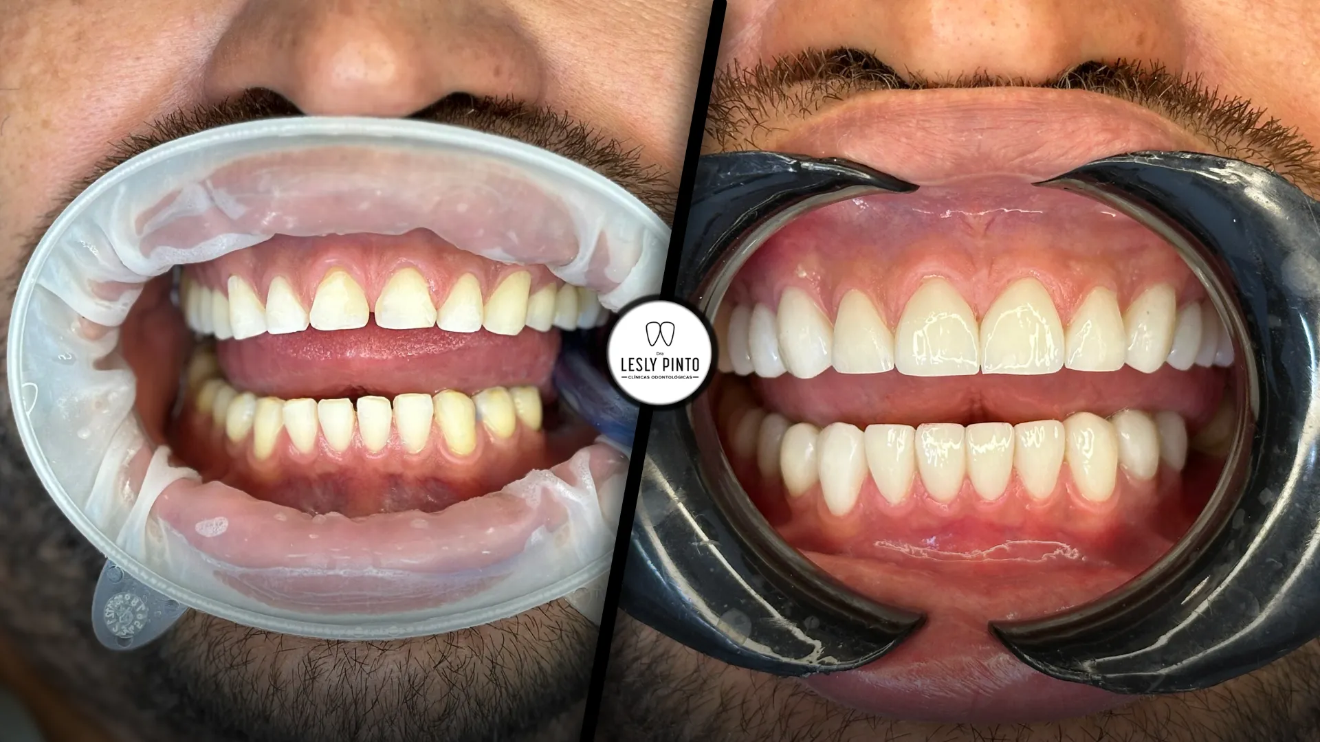 Successful case of veneers in colombia