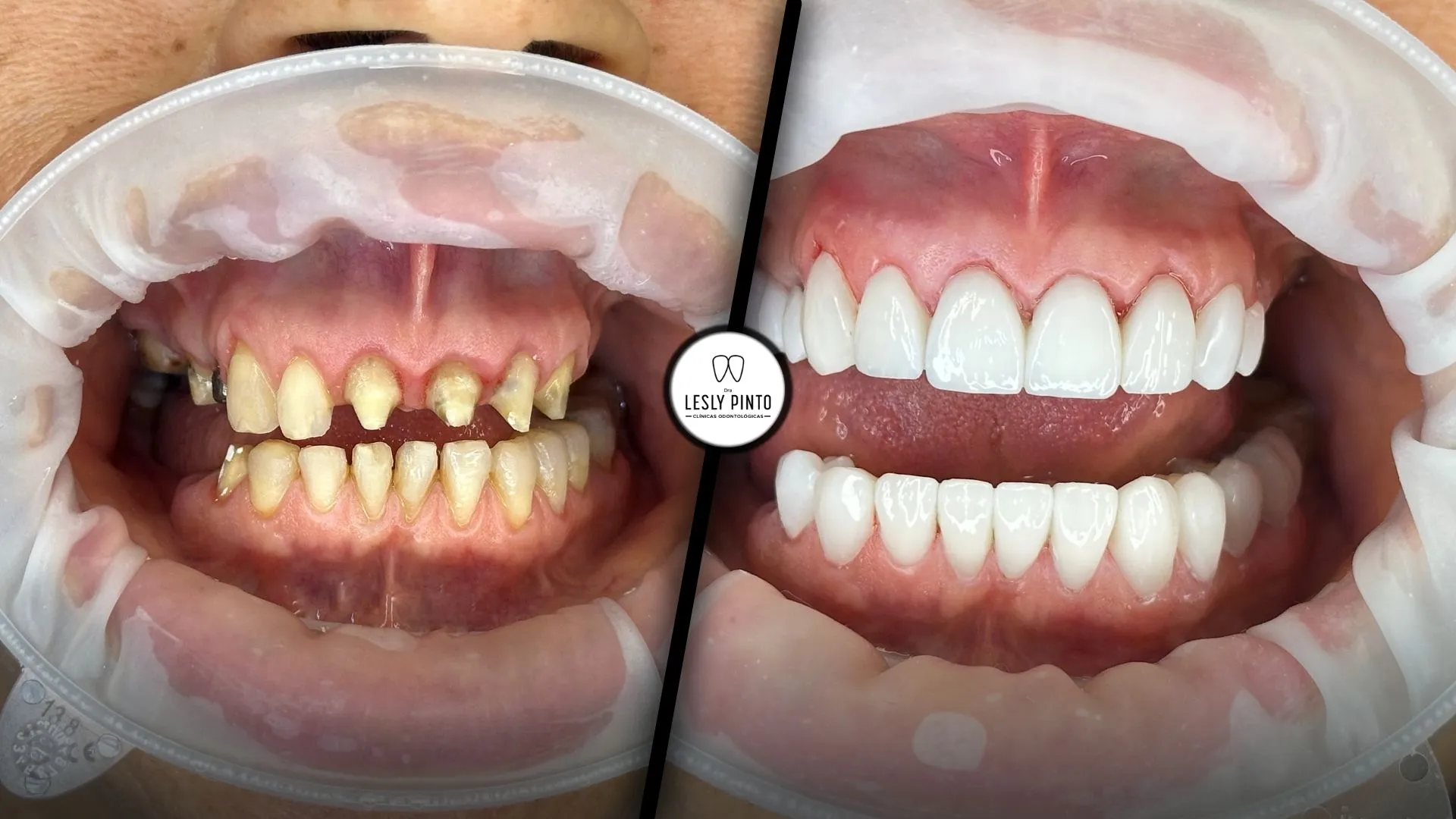 Porcelain veneers