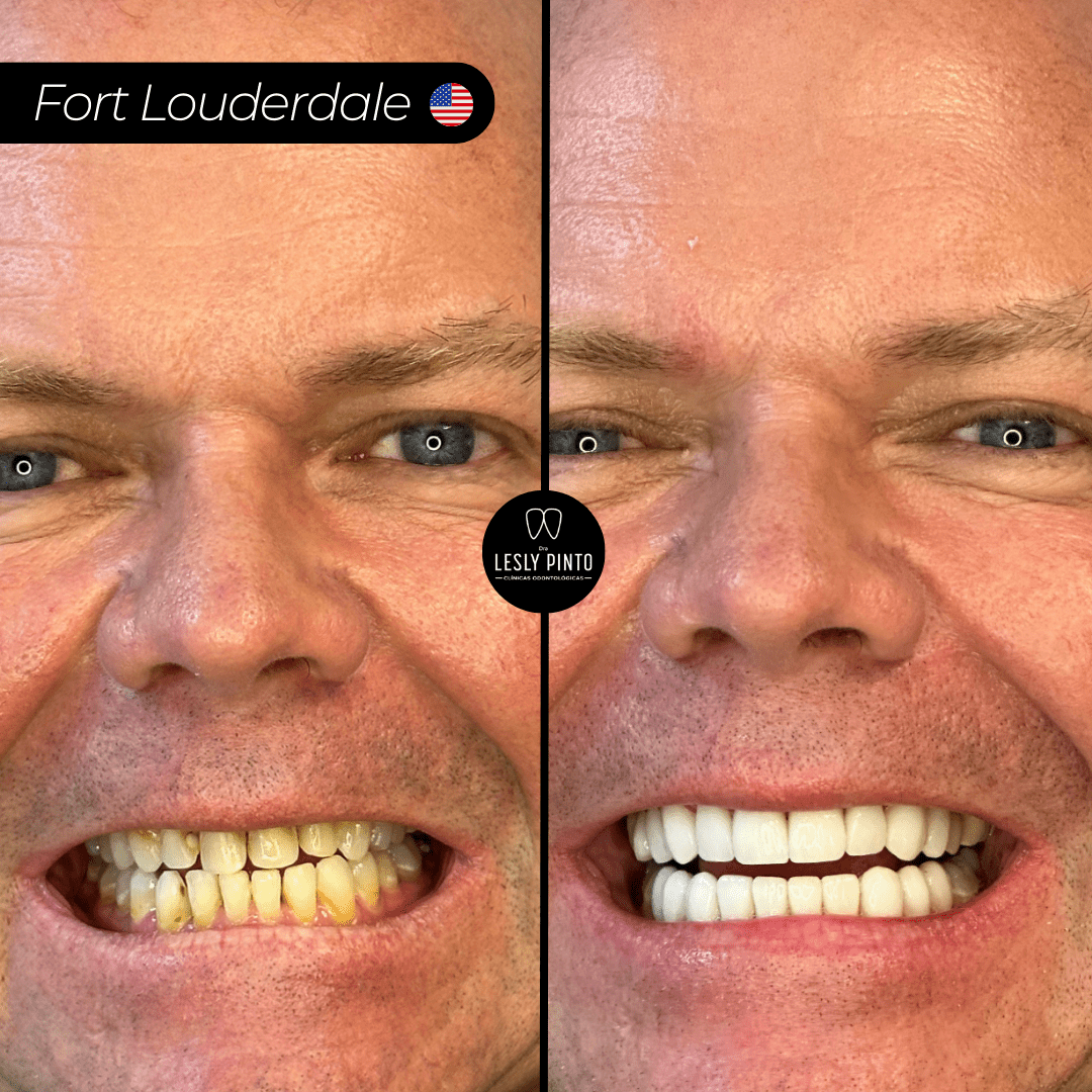 Results - 20 porcelain veneers in medellin, colombia for patient from FORT LOUDERDALE - BA-min
