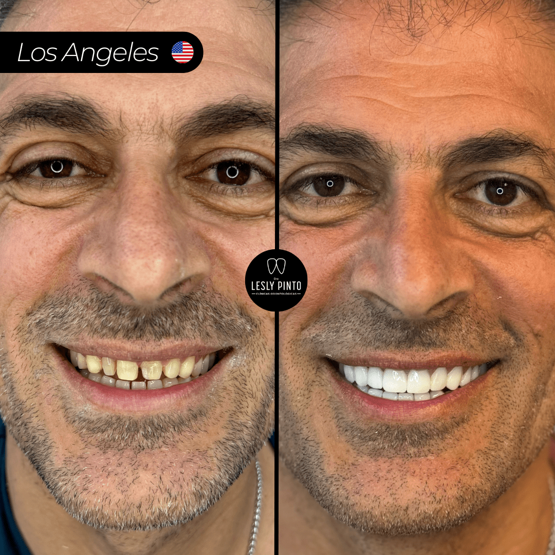 Results - 20 porcelain veneers in medellin, colombia for patient from  LOS ANGELES - BA (2)-min