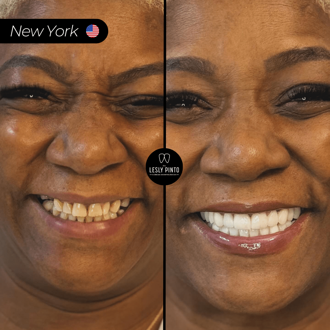 Results - Porcelain veneers in medellin colombia - 1