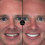 resultados-porcelain-veneers-dra-lesly-pinto-_2_-min