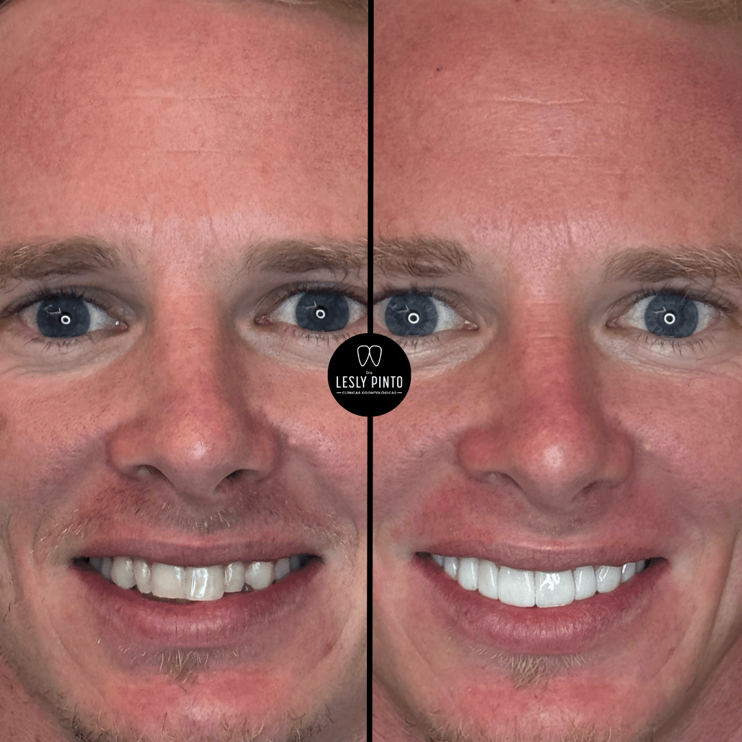resultados-porcelain-veneers-dra-lesly-pinto-_2_-min