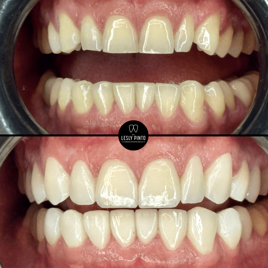 Results - Porcelain veneers in colombia - 6