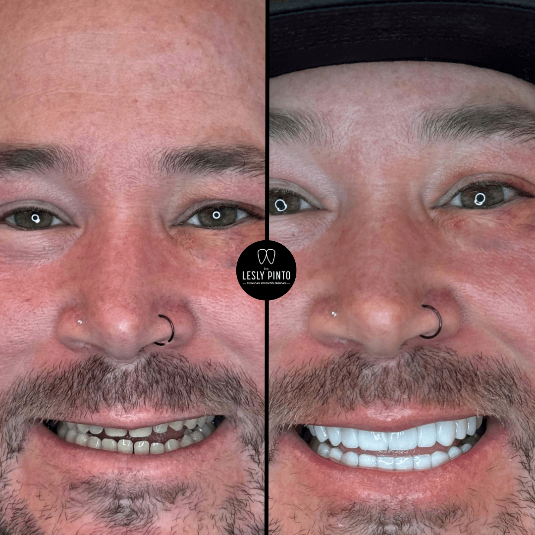 results-porcelain-veneers-dra-lesly-pinto-min