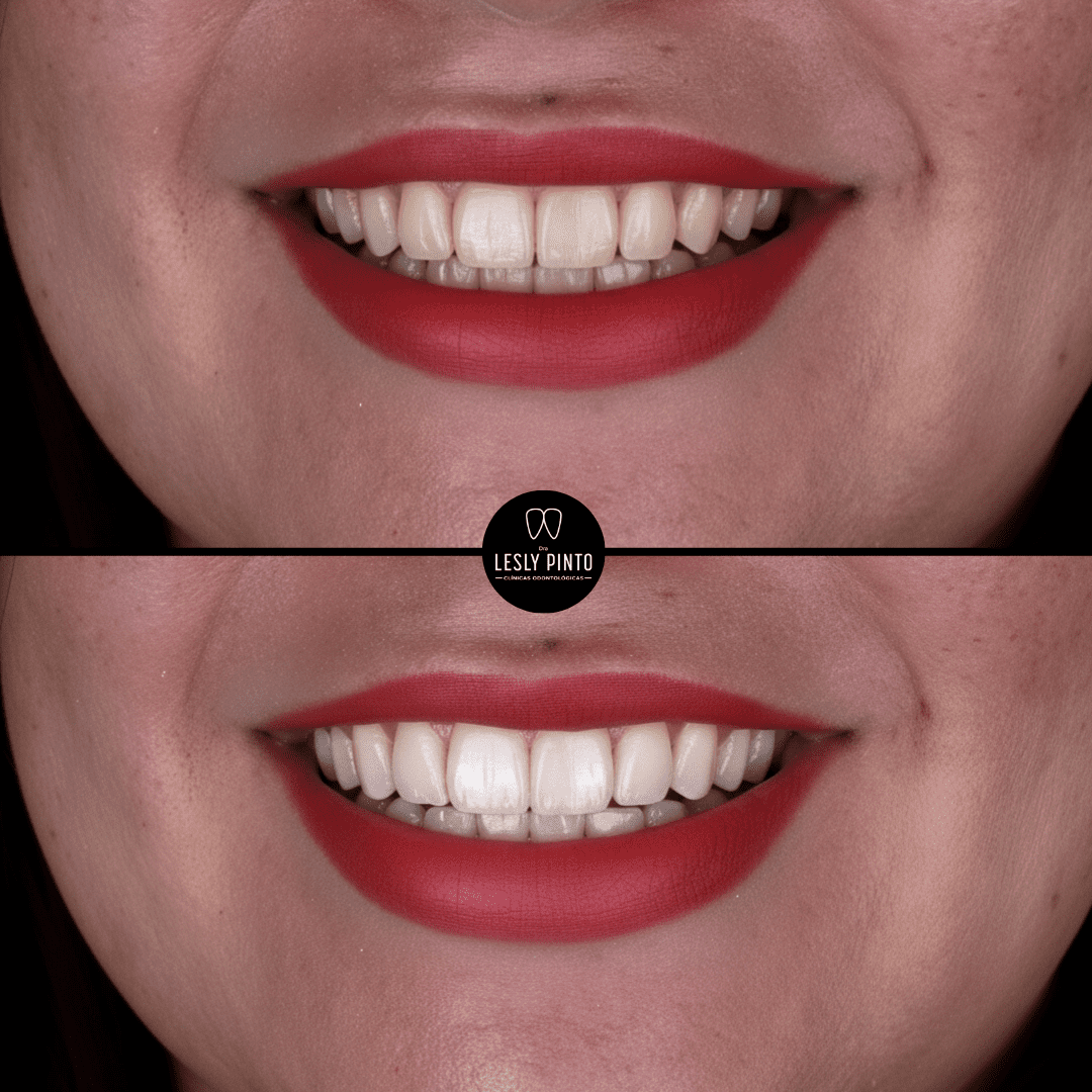 Teeth whitening in medellin - patient 1