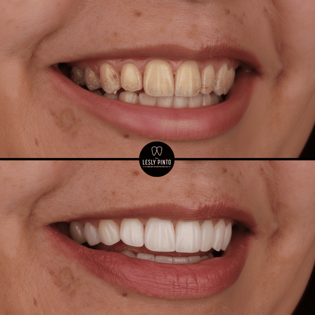 Theeth whitening in medellin - patient 2