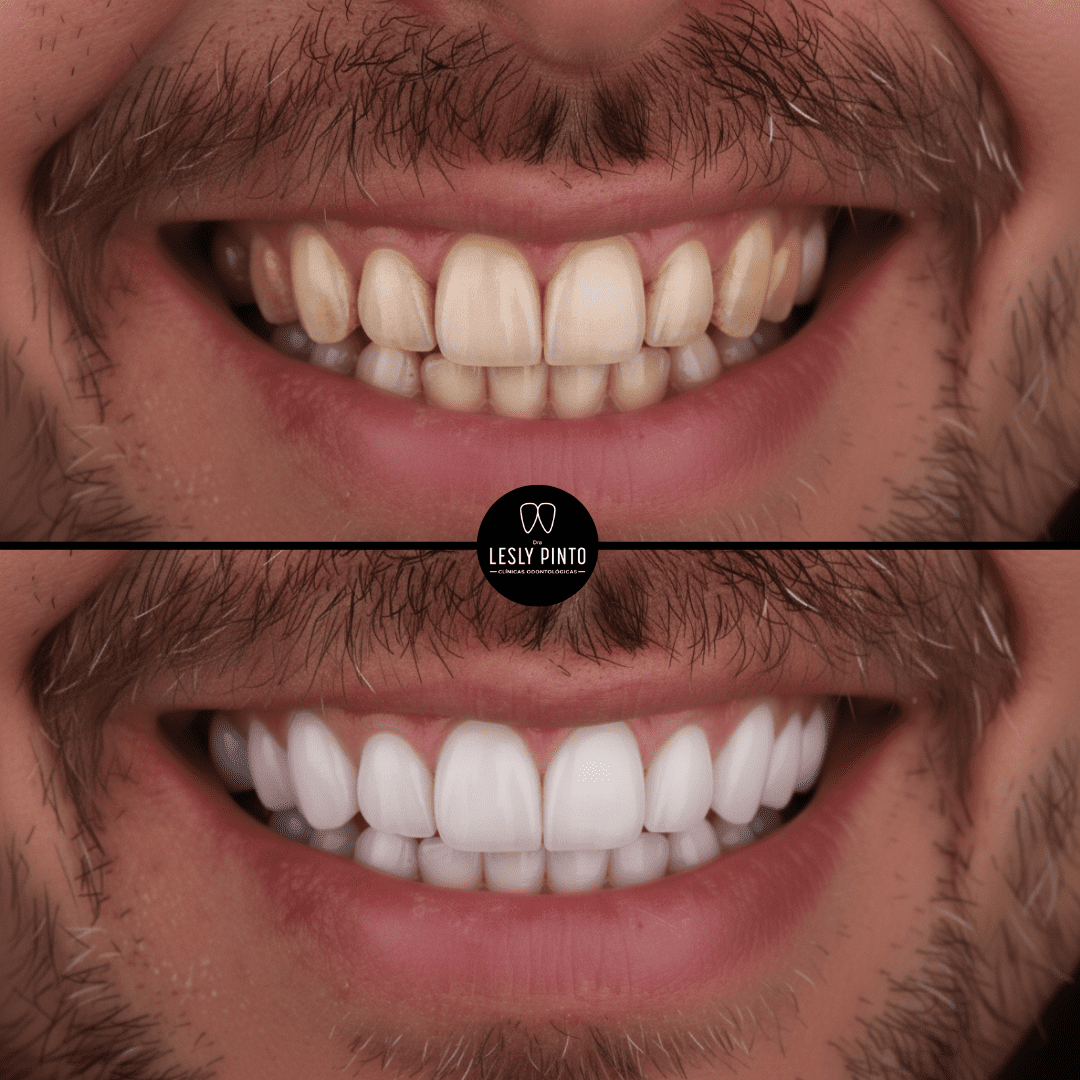Theeth whitening in medellin - patient 3
