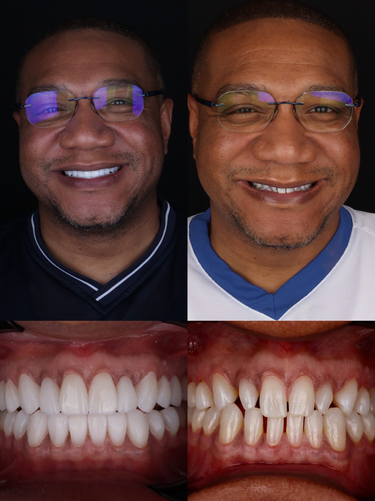 dental veneers in medellin - patient 6
