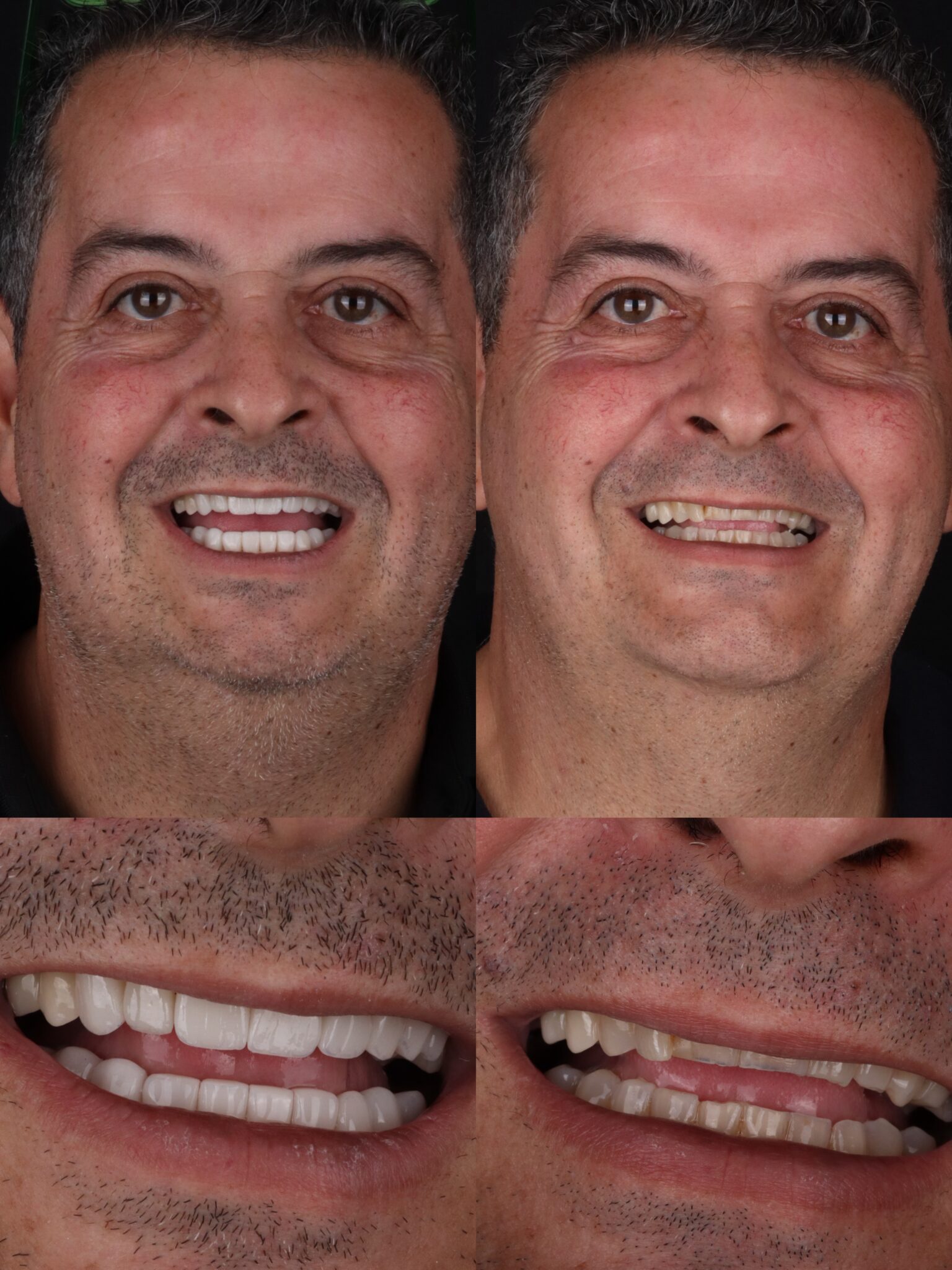dental veneers in medellin - patient 7