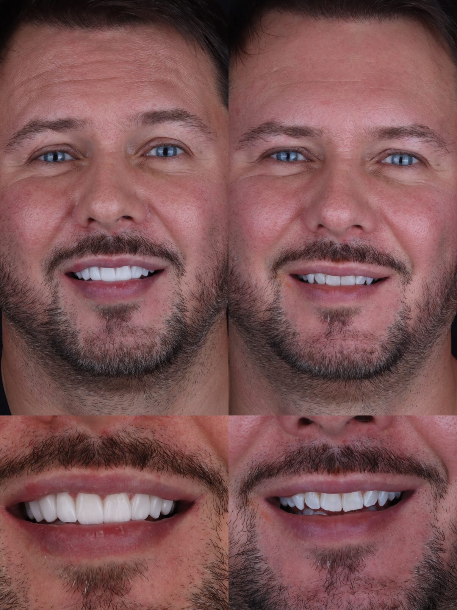dental veneers in medellin - patient 5