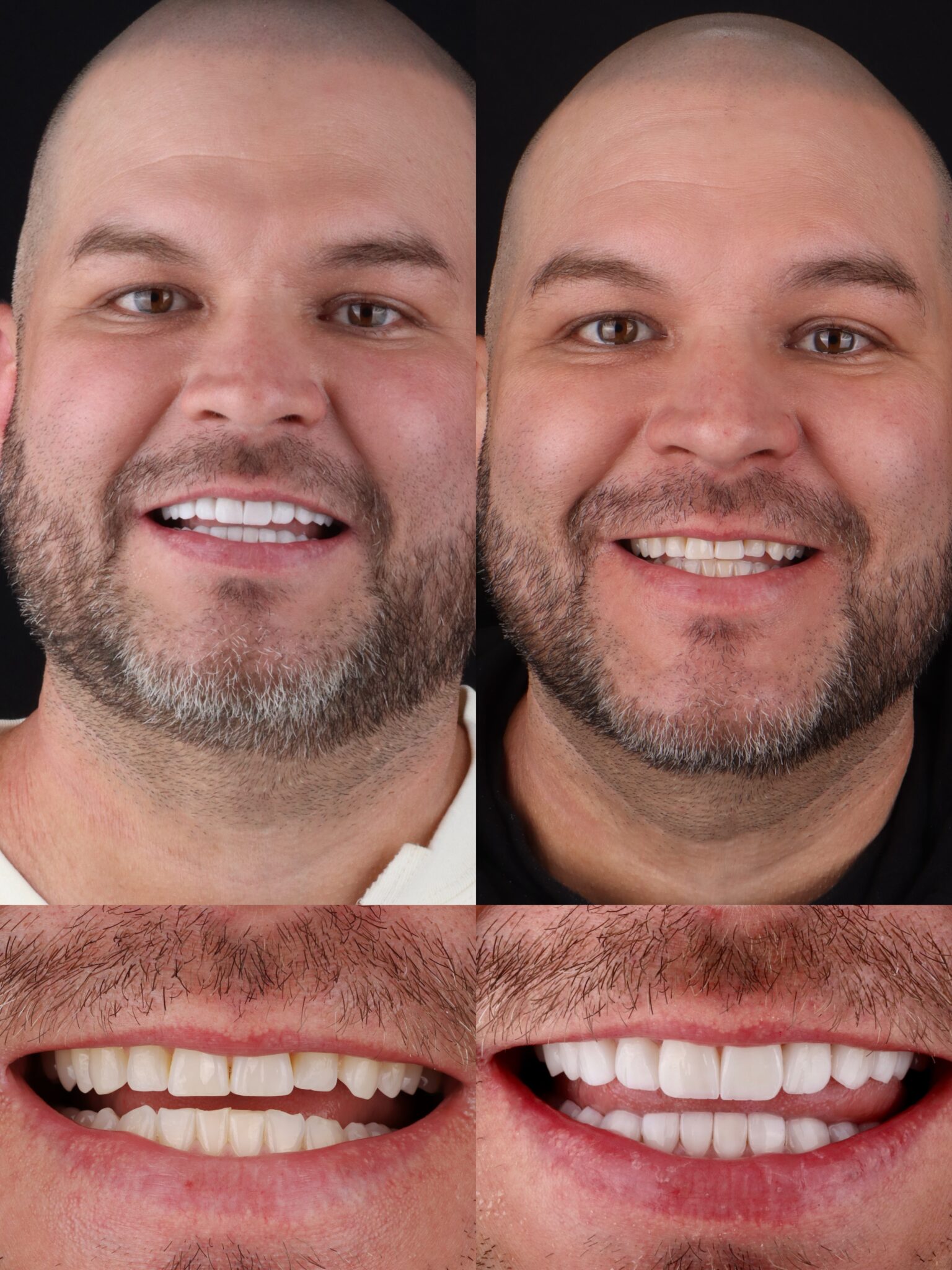 dental veneers in medellin - patient 5