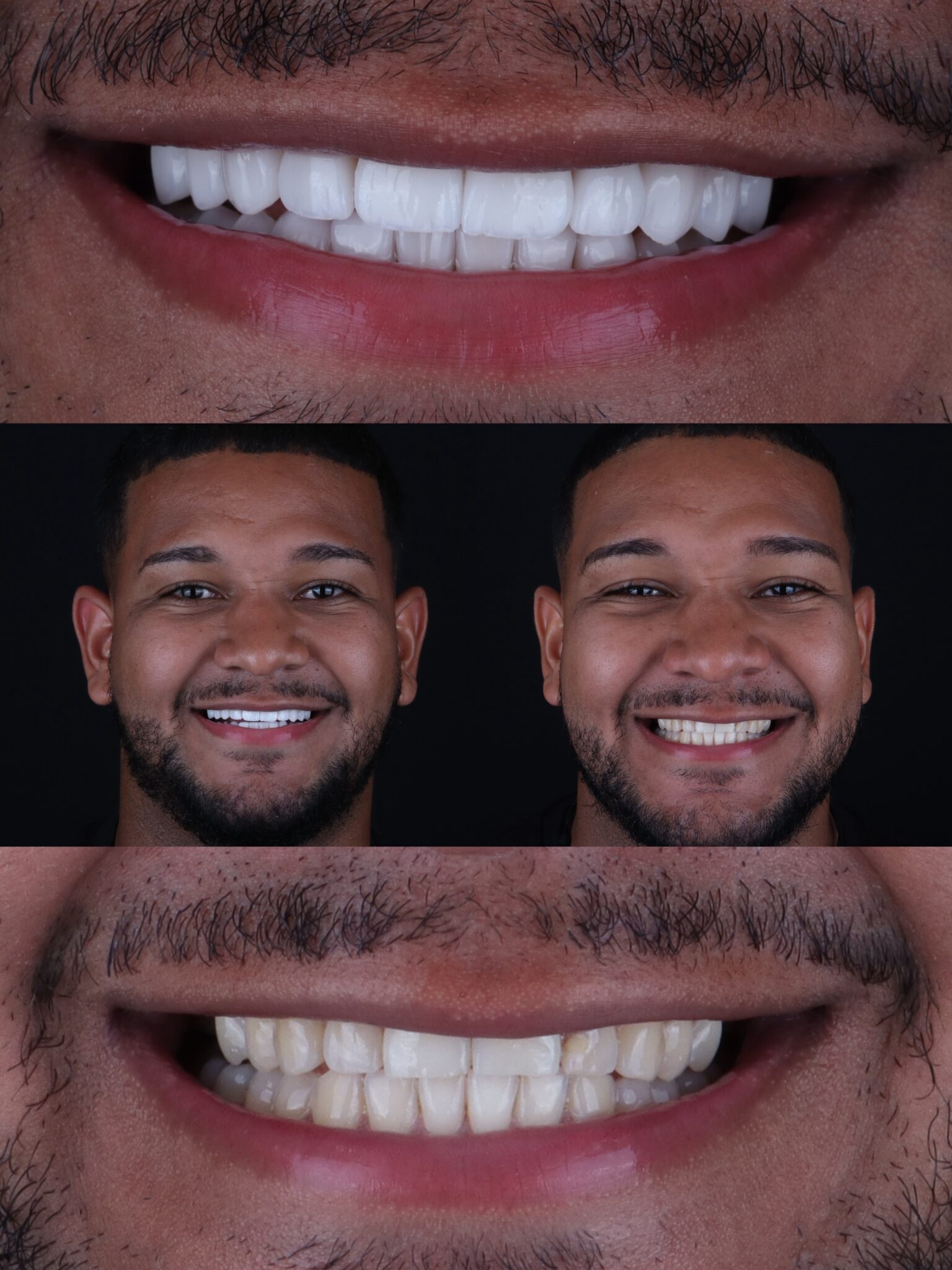 dental veneers in medellin - patient 9